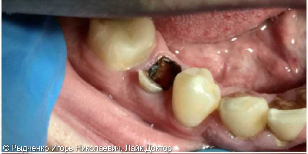 Восстановление травматических отломов коронок зубов