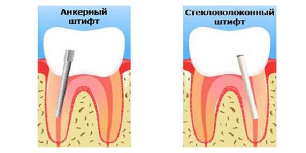 Реставрация корня зубов