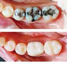 Восстановление зуба с помощью искусственной коронки
