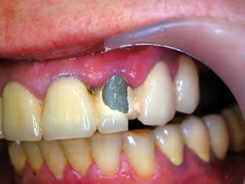 Полное разрушение коронки зуба