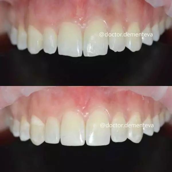Частые вопросы о восстановлении режущего края зуба: