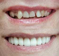 Реставрация кривых зубов