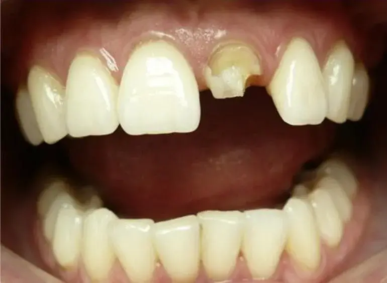 Различные варианты восстановления культи зуба композитным материалом химического отверждения «ДентаКор»