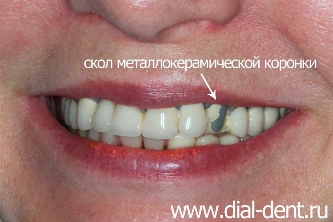 Реставрация металлокерамических зубов — эффективное восстановление утраченной функции и эстетики