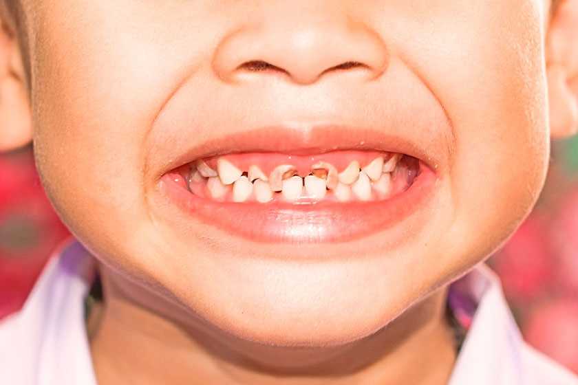 Реставрация молочных зубов — эффективные методы восстановления здоровья и эстетики детской улыбки