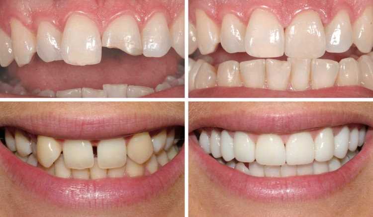 Реставрация переднего зуба пломбой