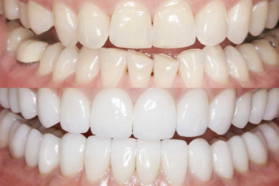 Реставрация зубов композитным материалом