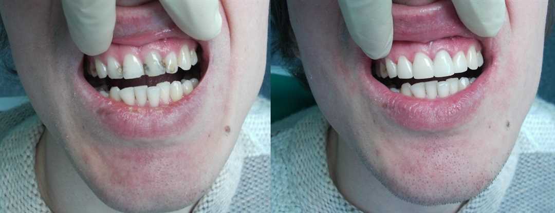 Сколько стоит реставрация зубов