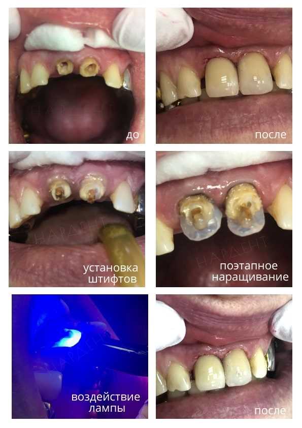Реставрация разрушенных зубов