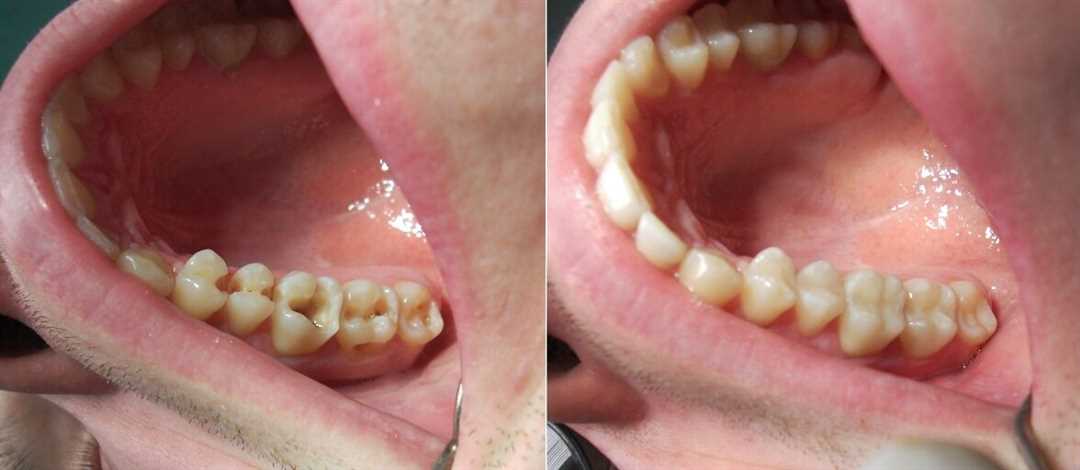 В каких случаях необходимо проводить реставрацию зубов?