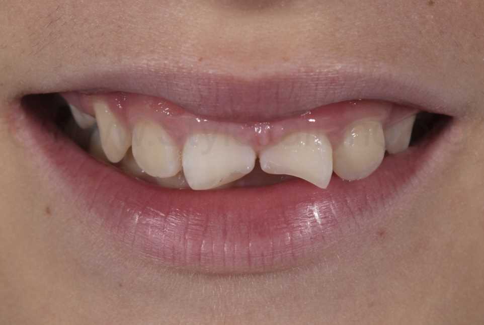 Реставрация постоянных зубов