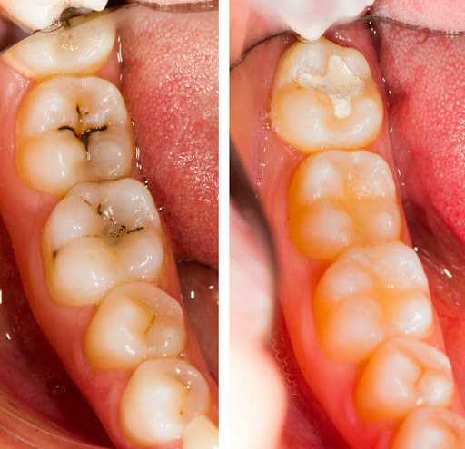 Преимущества протезирования жевательных зубов у детей