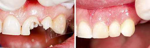 Реставрация разрушенного зуба