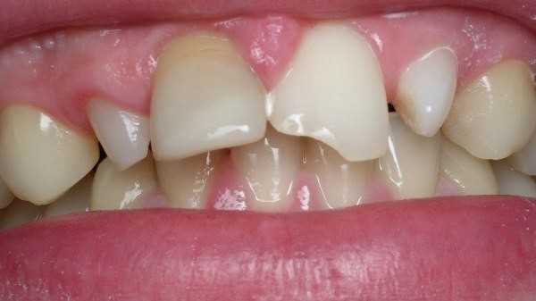 Реставрация шиловидного зуба — восстановление эстетики и функциональности зубочелюстной системы