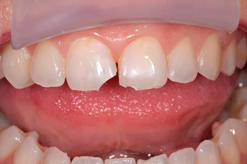  Причины скола зуба 