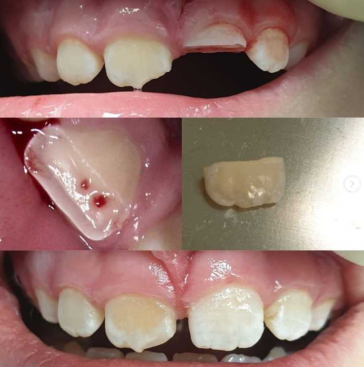 Cломана коронковая часть переднего зуба