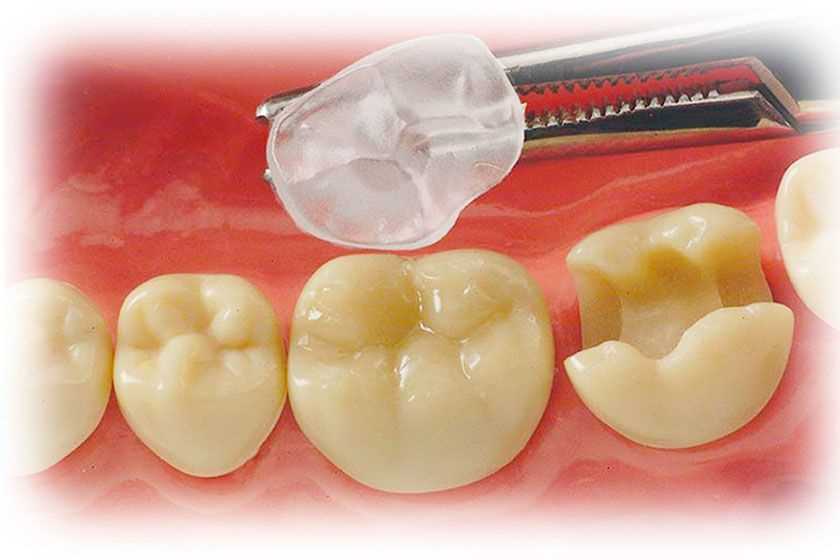 Эффективные способы восстановления зубов