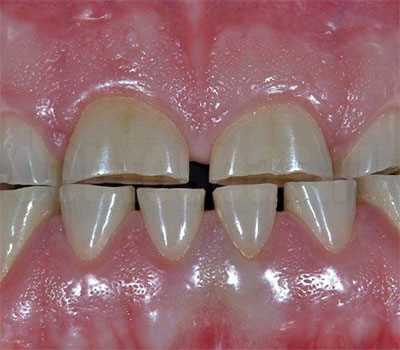 Реставрация стираемости зубов