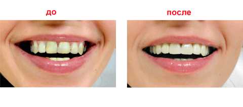 Методы восстановления сломанного зуба