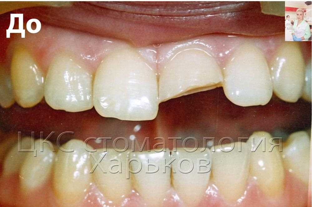Первласная методика реставрации ткани эмали и дентина зуба путём применения нанотехнологий