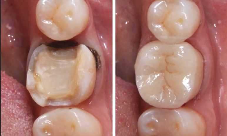 Запишитесь на бесплатную консультацию по восстановлению зуба