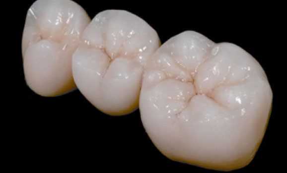Реставрация жевательных зубов - Стоимость услуг