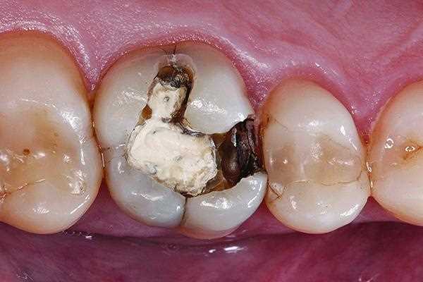 Как реставрируют жевательные зубы прямым методом?