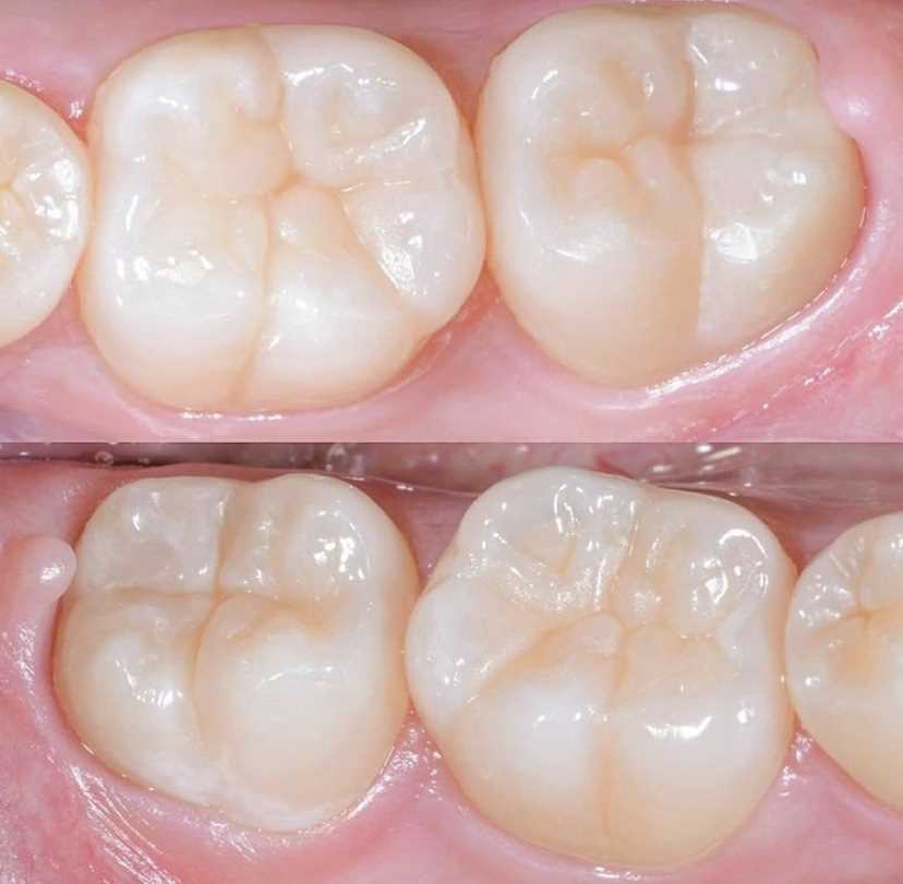 Реставрация зуба 4