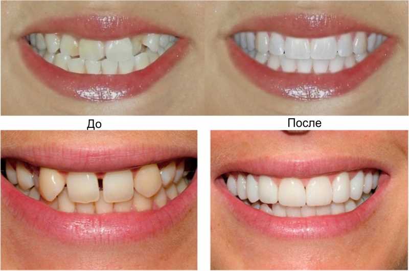 Реставрация зуба клиники