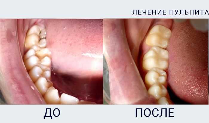 Качественная реставрация зуба на штифте – сохранение здоровья и естественной красоты вашей улыбки