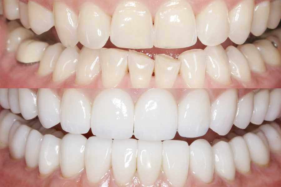 Как происходит наращивание зуба