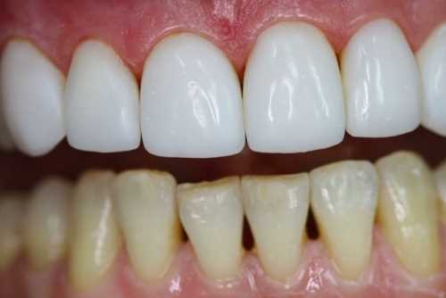Реставрация зуба наращивание