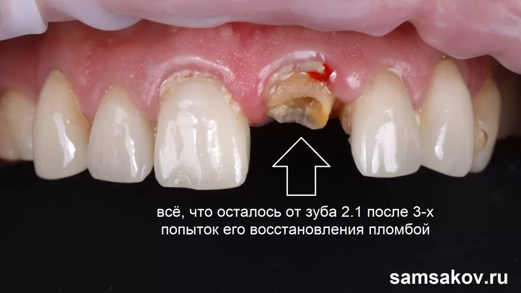 Причины разрушения зубов