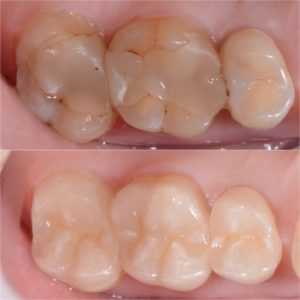 Когда неясно, проводить реставрацию зубов или пломбирование