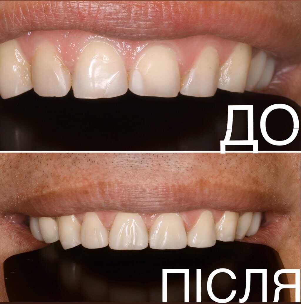 Реставрация зуба показания