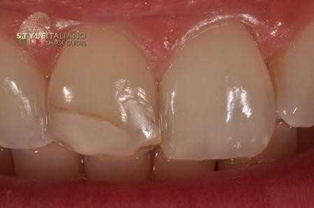 Эстетическая реставрация фронтальных зубов композитным материалом