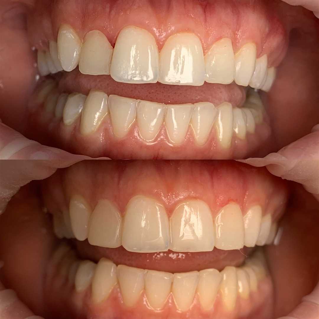 Реставрация зуба резца