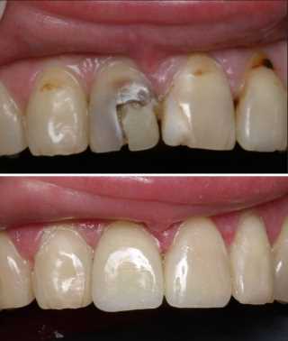 Этапы реставрации передних зубов