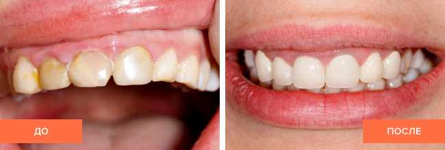 Сколько времени занимает процесс реставрации зуба?