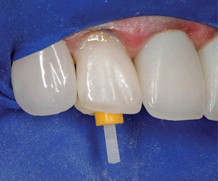 Реставрация зубов с помощью стекловолоконных штифтов