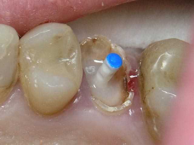 Реставрация зуба с применением стекловолоконного штифта — технология, преимущества и рекомендации