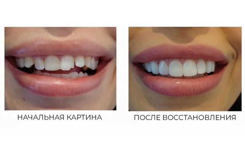 Реставрация зубов светоотверждаемыми материалами