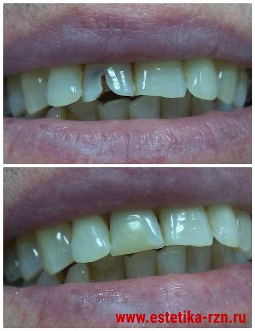Реставрация зуба светоотверждаемым материалом