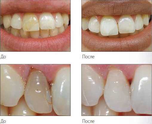 Недостатки световых материалов для реставрации зубов: