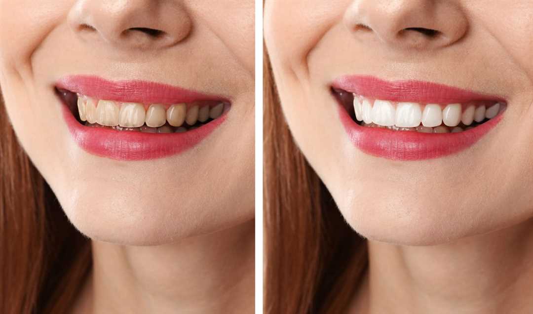 Больно ли реставрировать зубы?