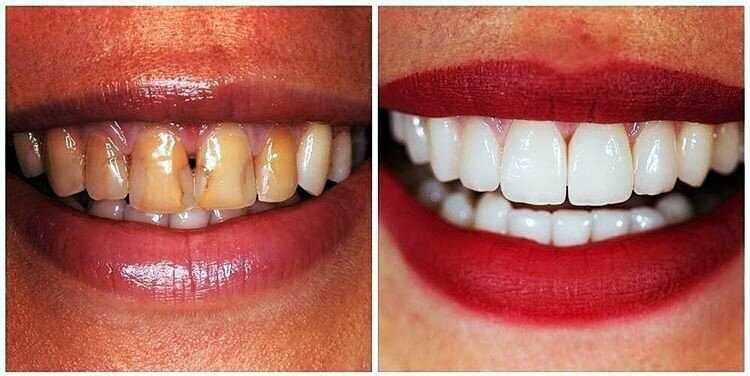 Какие существуют показания к реставрации зубов?