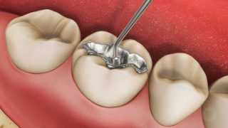 Реставрация зубов амальгамой