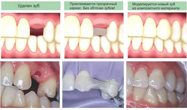 Непрямой метод реставрации передних зубов