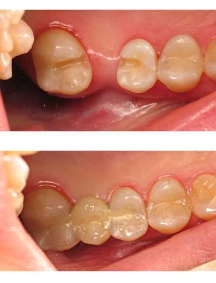 Реставрация зубов без обточки