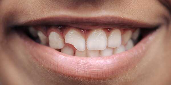 Наращивание зубов: показания и этапы проведения процедуры